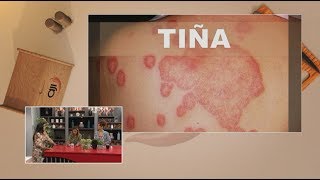 Dermatología Tiña corporis Hongos en la piel [upl. by Aihsit]