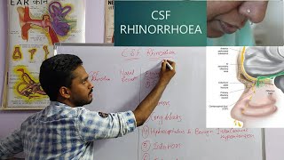 CSF RHINORRHEA  ENTNOSE [upl. by Onaicnop]