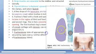 ENT Tracheostomy technique steps [upl. by Jeremiah]