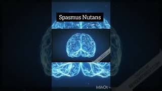 Spasmus Nutans [upl. by Hannasus64]