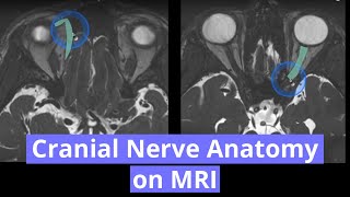 Cranial Nerve Anatomy on MRI [upl. by Gnilrac961]