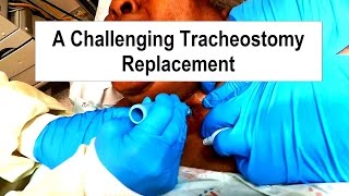 A Challenging Tracheostomy Replacement [upl. by Auberon]