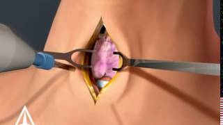 Tracheotomy  3D animation [upl. by Aneehta]