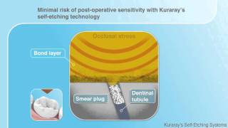 Kuraray Selfetch demonstration  dental use [upl. by Ranit]