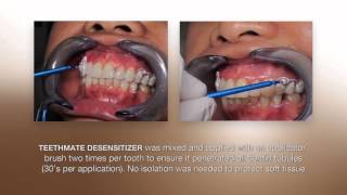 Desensitizing Procedure using the NEW TEETHMATE DESENSITIZER from Kuraray [upl. by Benny]