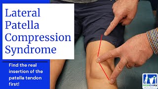 Lateral Patella Compression Syndrome LPCS [upl. by Amorete]