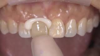 How to Use Kerr Nexus RMGI Resin Modified Glass Ionomer Cement [upl. by Persian101]